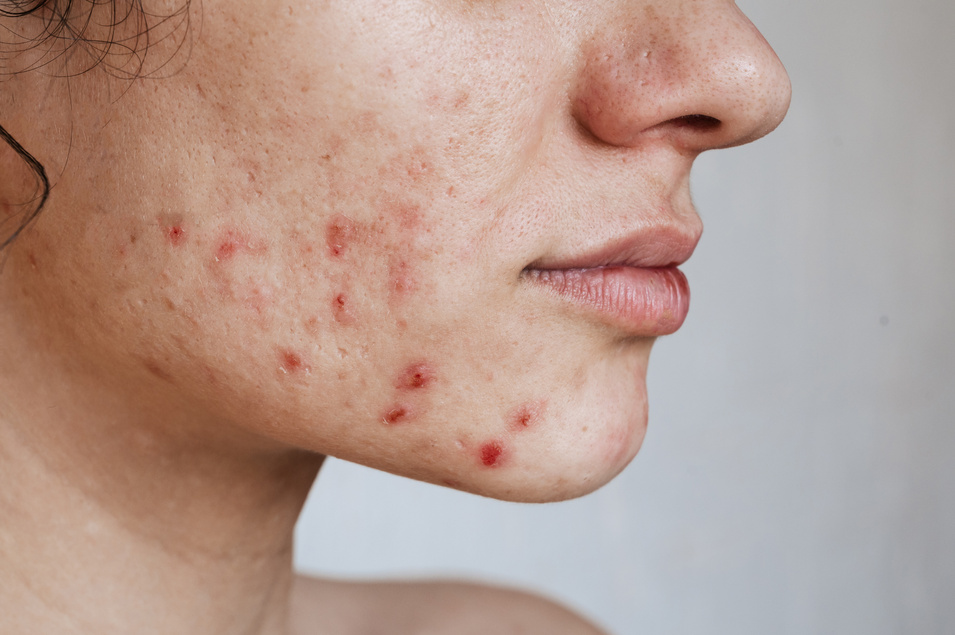 Close-up of the skin of a young girl with problems. Pimples, acne, pores, scars. Natural skin without filters